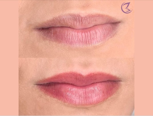 Nanopigmentação Labial na Estética Bali