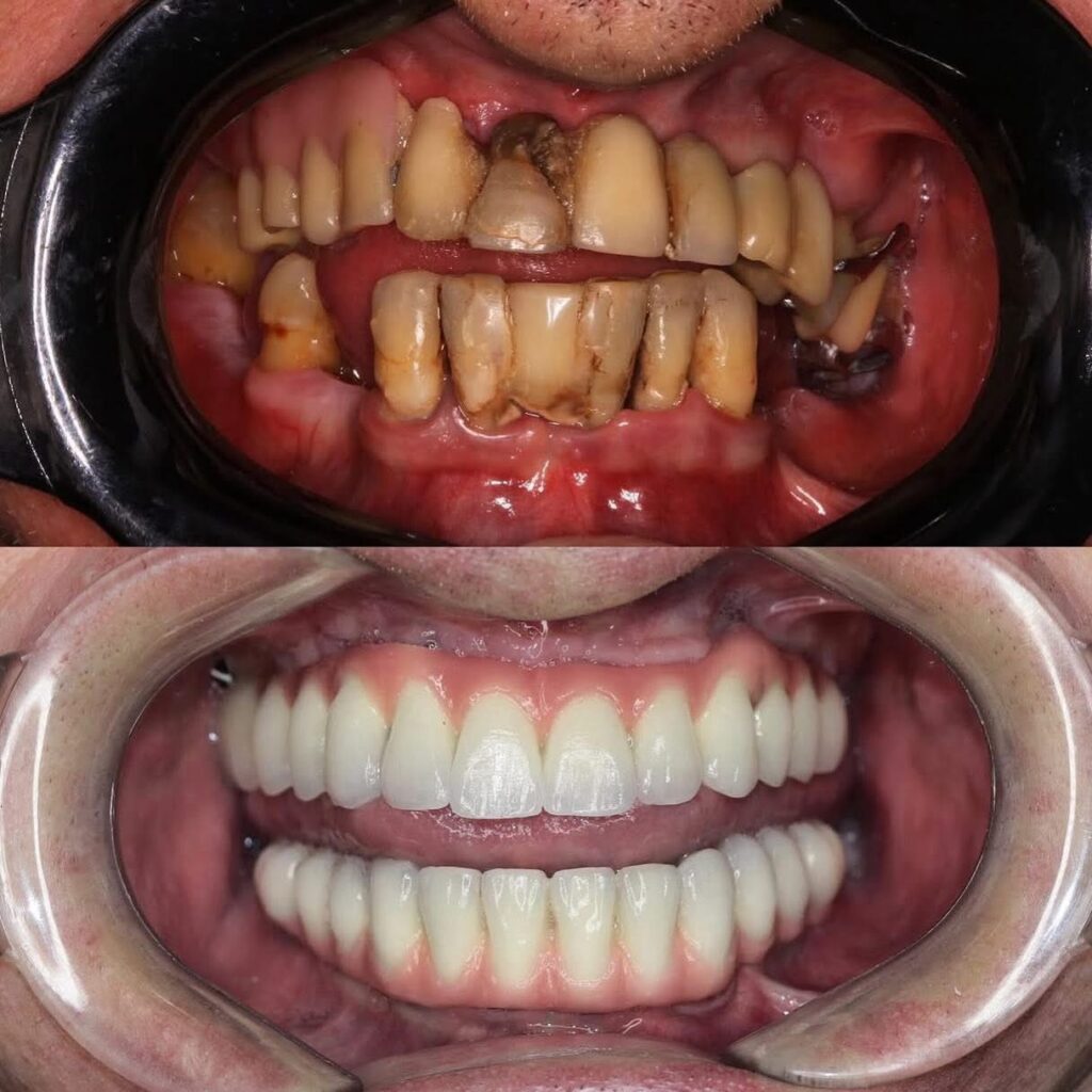 Implantes dentários Clínica Odontológica La Belle
